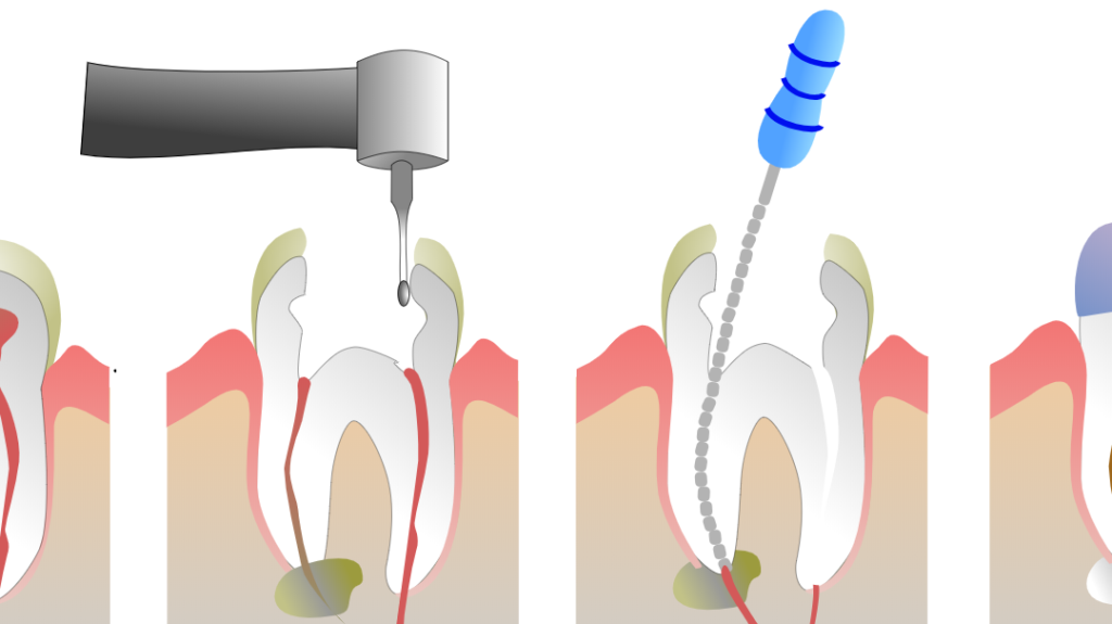 root-canal-procedure-step-by-step